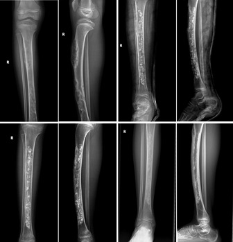 Bone graft X-rays